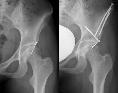 The preoperative AP radiograph of a 26-year-old female patient (left) is shown in comparison to the postoperative radiograph 