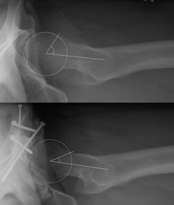 preoperative cross table view 