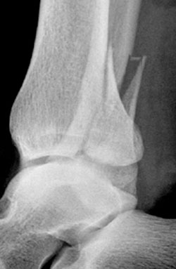 Ankle fracture