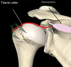 the graft is attached medially to the superior tubercle of the glenoid and laterally to the greater tuberosity.