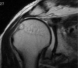 Coronal MRI scans are shown preoperatively.