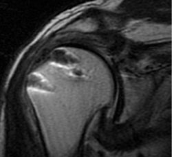 Coronal MRI scans are shown 1 year after arthroscopic superior capsule reconstruction