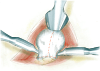  inverted T-shaped capsular incision