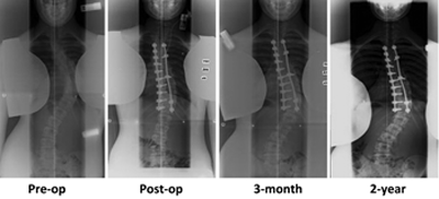 distal adding-on