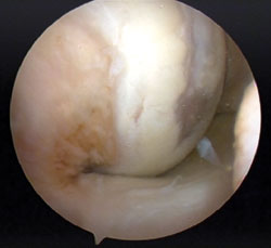 an arthroscopic view of a full-thickness cartilage lesion on the femur