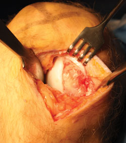 A large full-thickness cartilage lesion on the femur is being  prepared for cartilage repair surgery