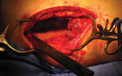 For most osteotomies, the chisel is placed perpendicular to the long axis of the femur. For this one it is angled from anterior distal to posterior proximal.