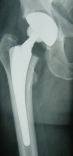 AP radiograph depicts one of the stems implanted