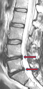 Consecutive, multilevel disc degeneration