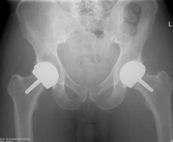 bilateral hip resurfacings