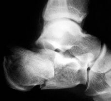 A displaced intra-articular calcaneal fracture