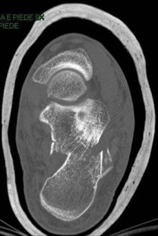 A CT scan shows the calcaneus fracture