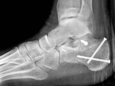 A fracture treated with a few screws placed through a 3-cm lateral skin incision