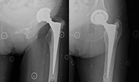 Radiostereometric analysis images taken at 60° to each other show the position of one patient’s prosthesis