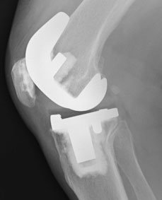 The Kinemax Plus Knee arthroplasty implant