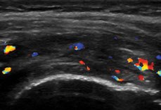 Vascularization on Power Doppler ultrasonography in a patient’s left shoulder