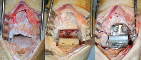 Talar cartilage loss and osteophytes in a varus arthritic ankle required TAA