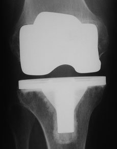 Cemented total knee replacement