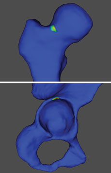 MRI reconstructions show femoroacetebular impingement