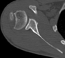 An extensive Hill-Sachs fracture and anterior glenoid bone loss