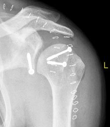 The patient was treated with a combined Latarjet procedure and transfer of iliac crest bone