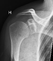 An open Scott osteotomy of the neck of the scapula and a modified Eden-Hubinette