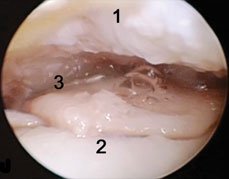 This arthroscopic view shows the tibia plafond