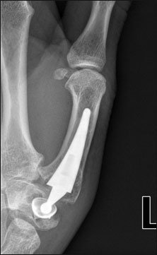 Excision arthroplasty