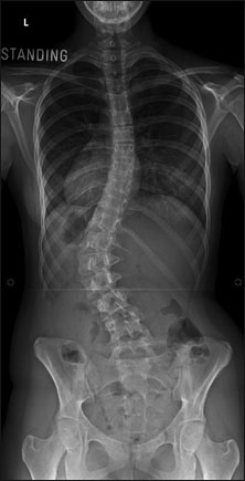 primary thoracolumbar scoliosis