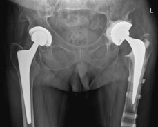 Hip revision