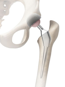 3D Hip prosthesis