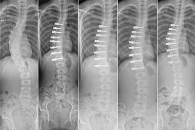 Scoliosis in children