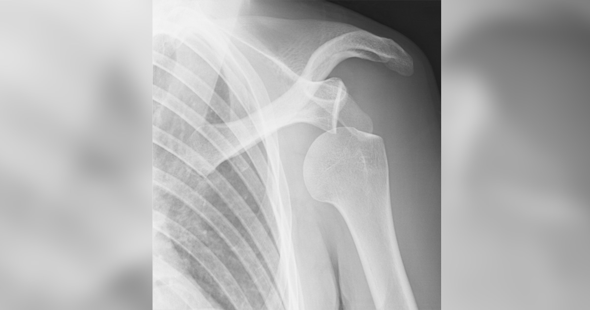 shoulder dislocation