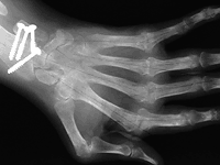 x-ray