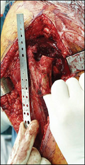 Bone Resection [photo]