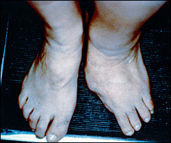 Charcot Foot [photo]