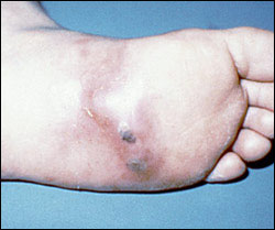 Charcot Foot [photo]