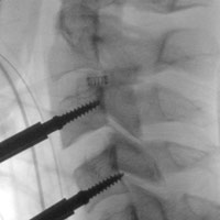 Implant of Prodisc-C prosthesis