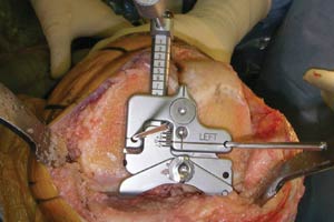 Resecting the distal femur