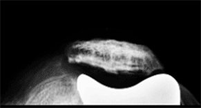 Postoperative radiograph 3