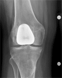 Postoperative radiograph 1