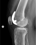 Postoperative radiograph 2