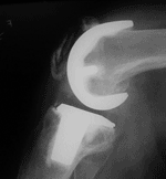 A loose patellar component