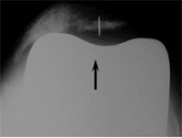 Patellar component loosening