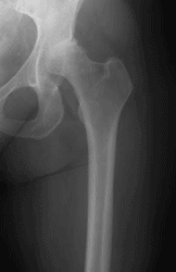 Narrow femoral canal.