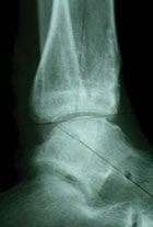 Post-distraction lateral X-ray