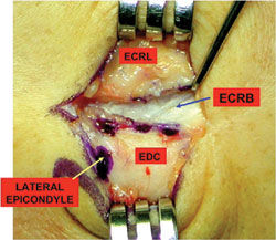 Lateral tennis elbow