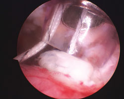 The platelet-rich matrix clot is pulled under