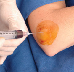 PRP injection in elbow