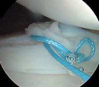 Arthroscopic image of a meniscal tear